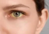 Yellow Eyes (Jaundice Eyes) treatment at Clairevision Eye Hospital Pune by Dr. Archana Singh