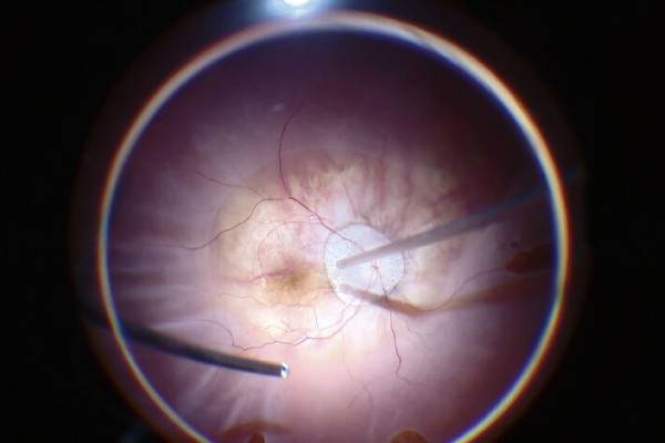 best retina surgeon in pcmc pune at clairevision eye hospital